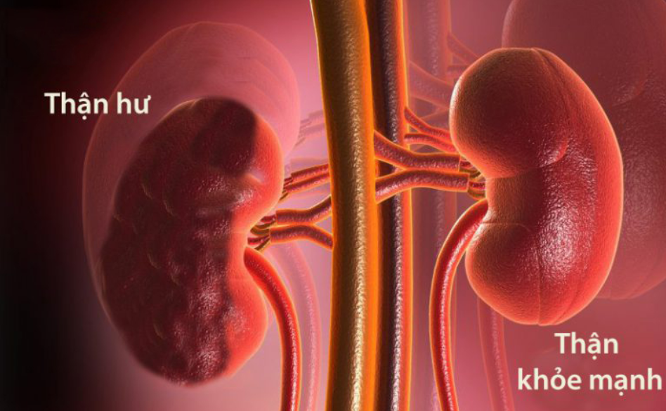 Thận yếu cũng khiến cho bệnh gút trở nặng hơn