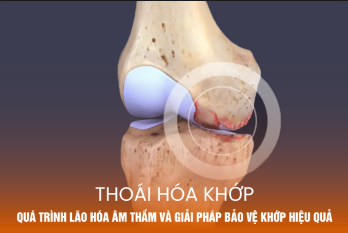 Thoái hóa khớp: Quá trình lão hóa âm thầm và giải pháp bảo vệ khớp hiệu quả