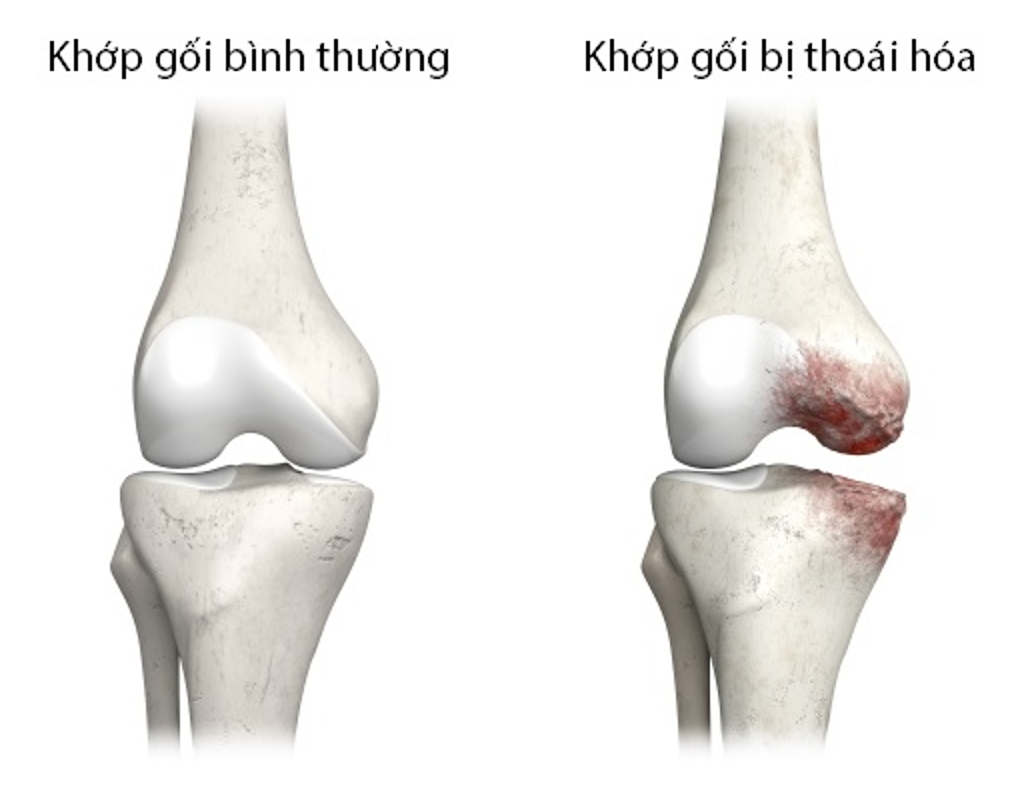 Hình ảnh so sánh khớp khỏe mạnh với khớp bị thoái hóa, sụn khớp mòn mỏng khiến hai đầu xương cọ xát gây đau