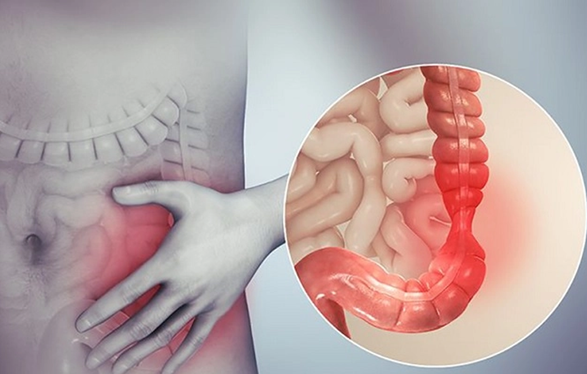 6 cách giúp cải thiện đại tràng co thắt hiệu quả, giảm tái phát