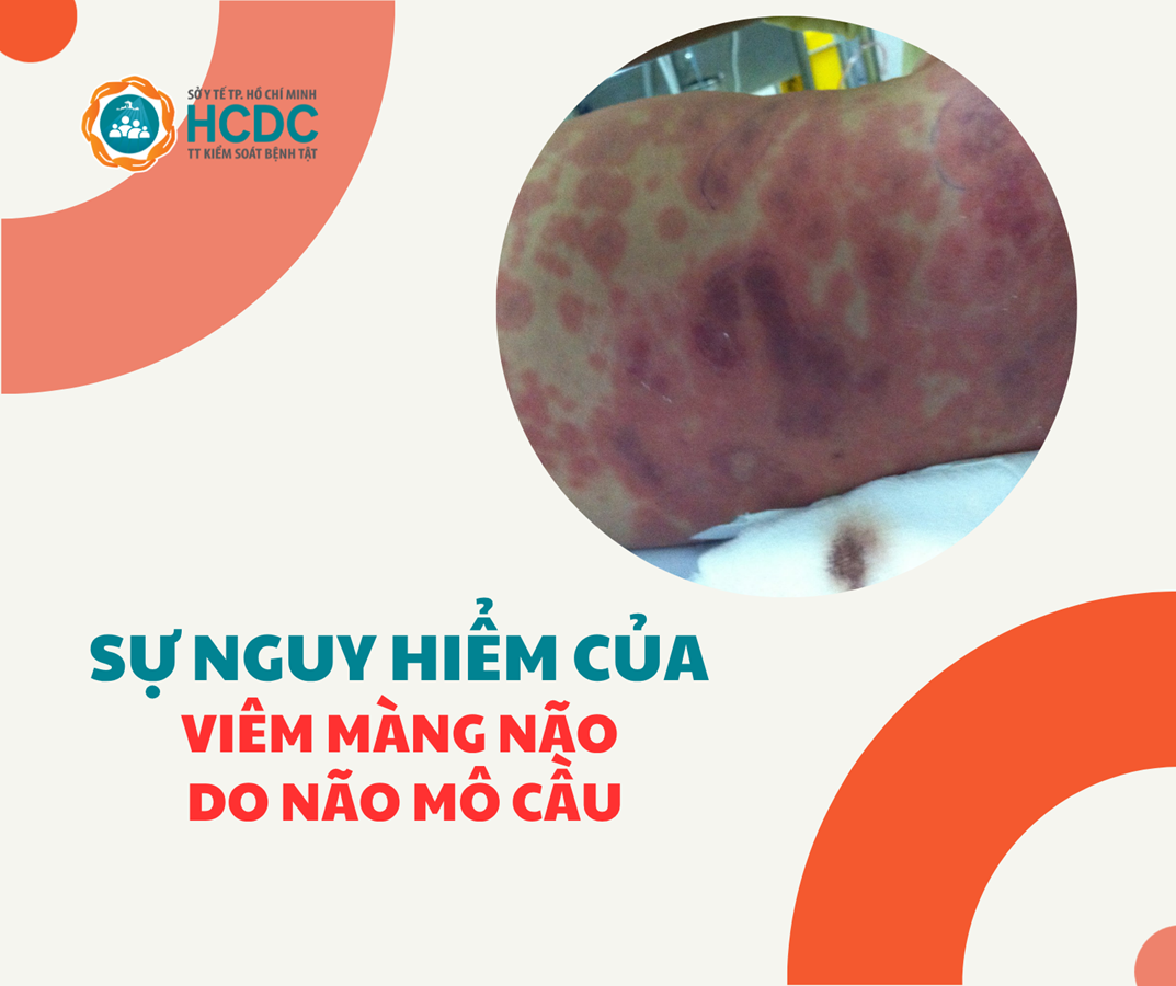 Bệnh não mô cầu gia tăng đột biến, cảnh báo về nguy cơ tử vong trong 24 giờ