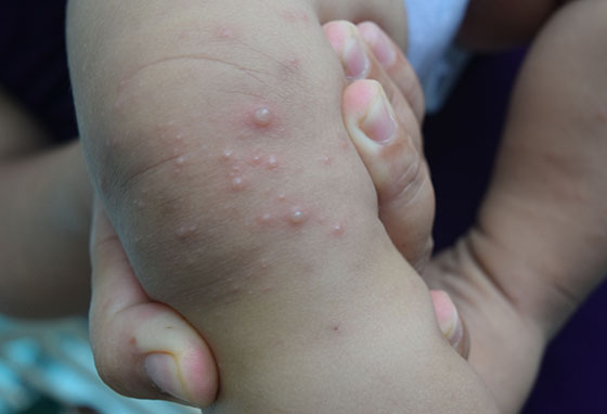 TP. HCM cảnh báo số ca mắc tay chân miệng tăng mạnh