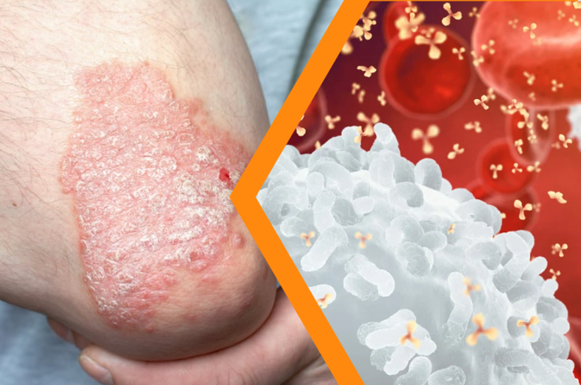 Điều trị vảy nến cần kết hợp giảm viêm trước mắt và ổn định miễn dịch lâu dài Điều trị vảy nến cần kết hợp giảm viêm trước mắt và ổn định miễn dịch lâu dài