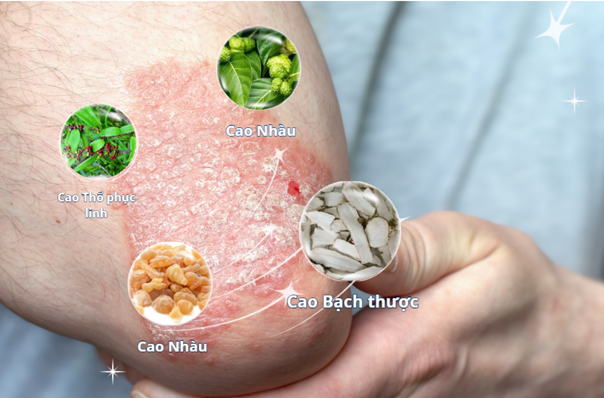 Các thảo dược như Bạch thược, Thổ phục linh, Nhũ hương, Nhàu hỗ trợ giảm ngứa, bong vảy và cải thiện sức đề kháng da Các thảo dược như Bạch thược, Thổ phục linh, Nhũ hương, Nhàu hỗ trợ giảm ngứa, bong vảy và cải thiện sức đề kháng da