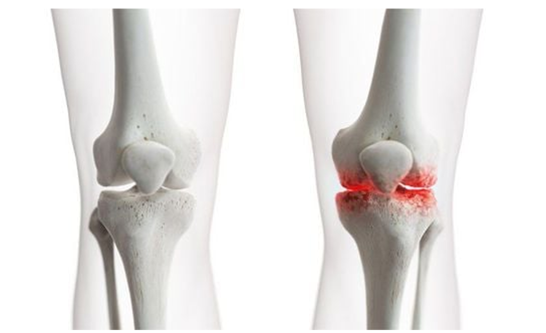 Khô khớp xảy ra khi cơ thể sản xuất không đủ chất nhờn để bôi trơn các khớp Khô khớp xảy ra khi cơ thể sản xuất không đủ chất nhờn để bôi trơn các khớp