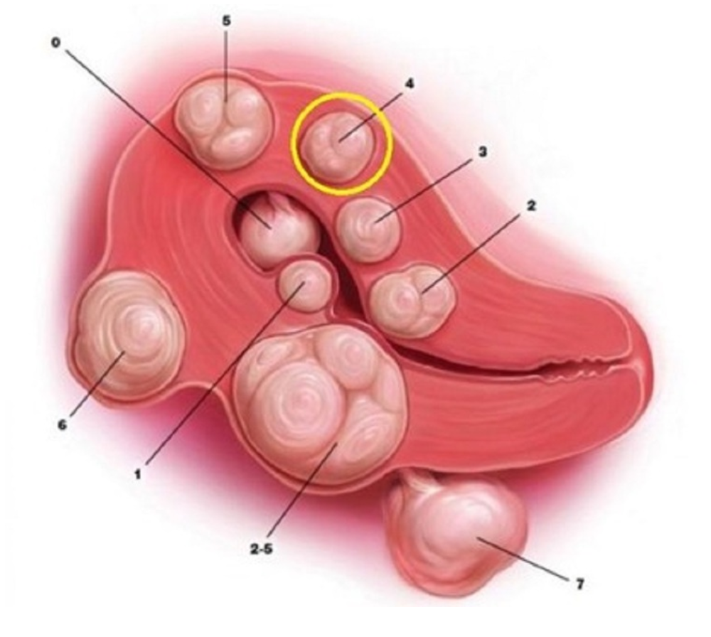 u xơ tử cung loại 4