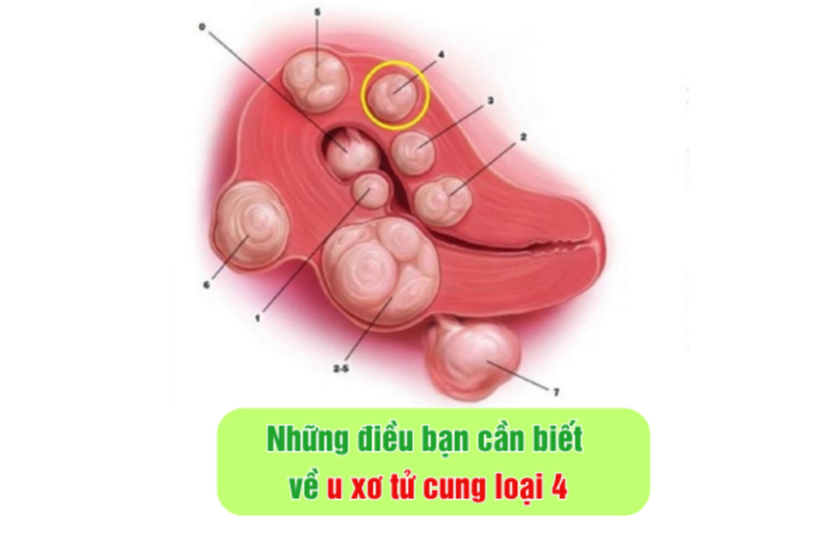 Những điều bạn cần biết về u xơ tử cung loại 4