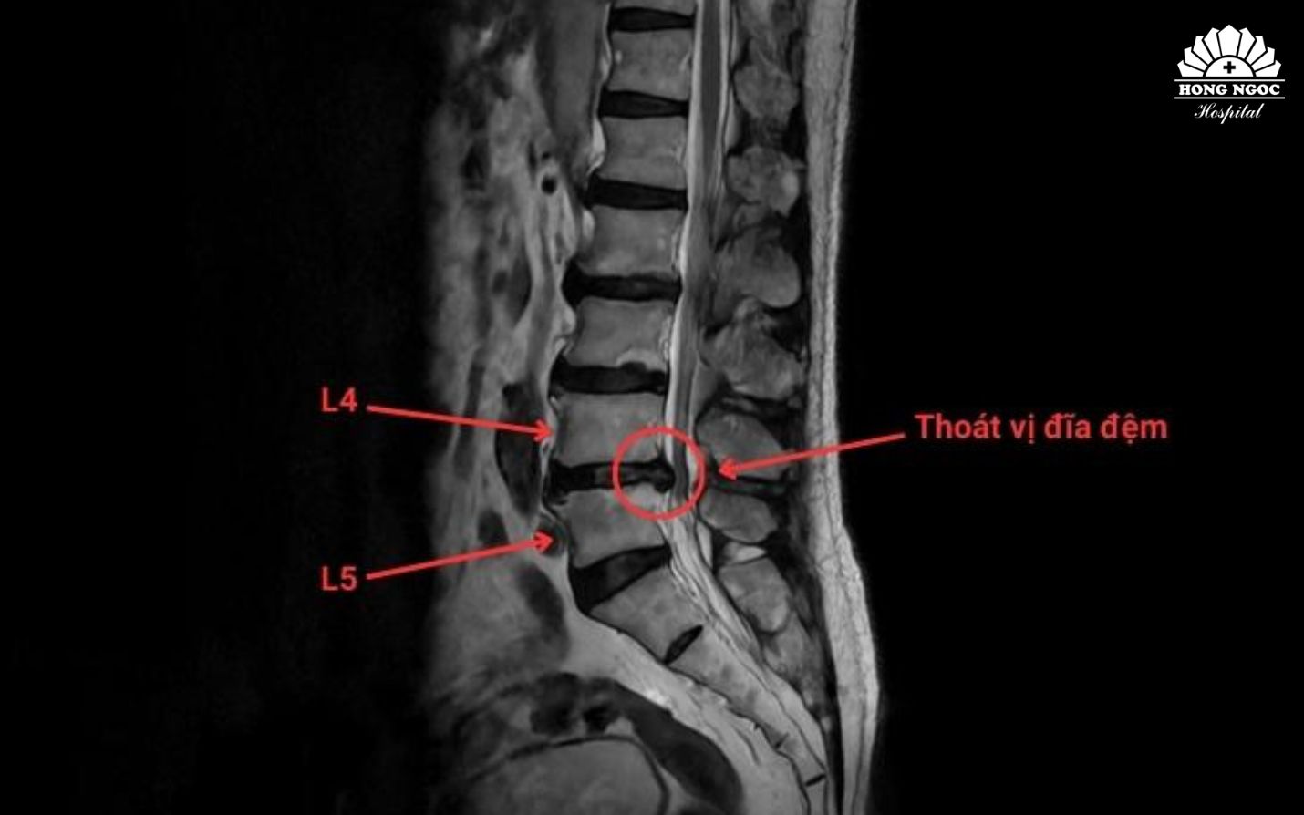 Phim chụp thoát vị đĩa đệm cột sống thắt lưng L4/L5