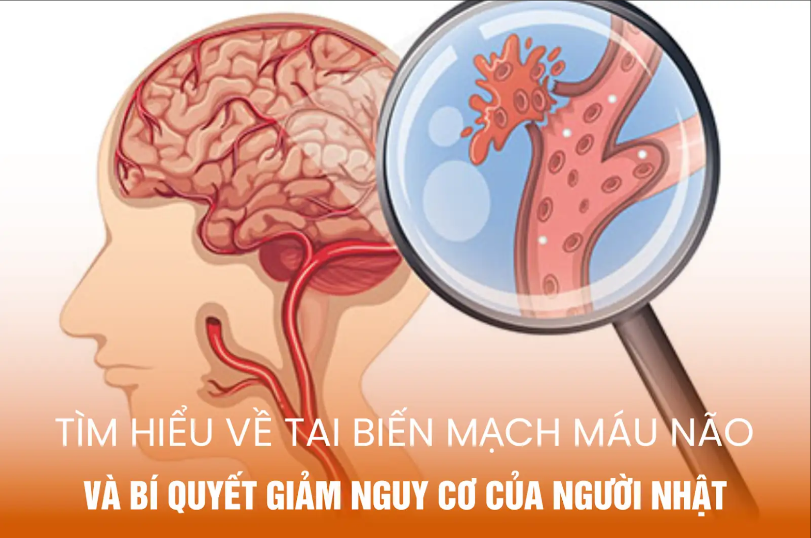 Tìm hiểu về tai biến mạch máu não và bí quyết giảm nguy cơ của người Nhật