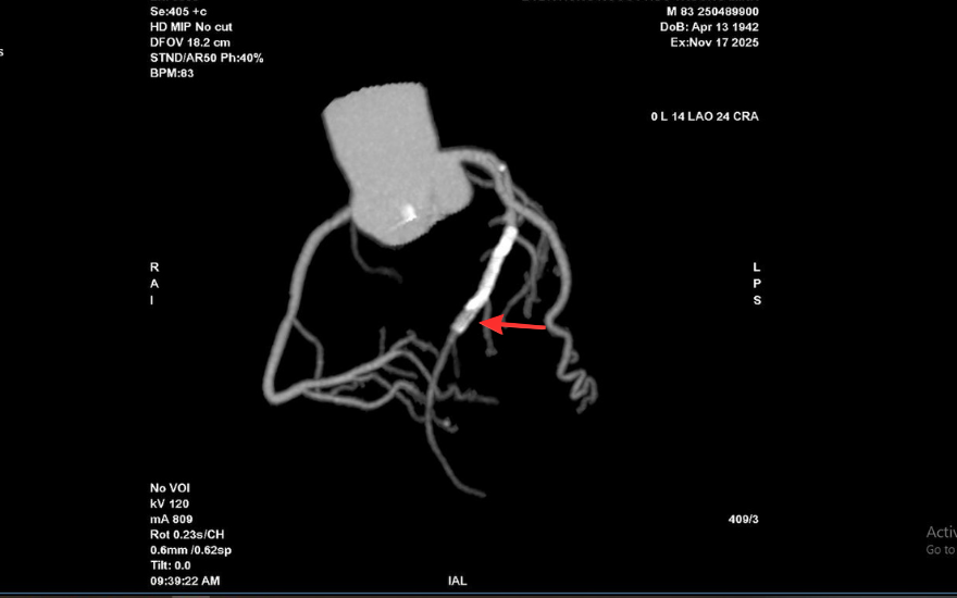 Vị trí hẹp khít trong lòng stent cũ của ông T trên hình chụp CT mạch vành 2560 lát cắt Vị trí hẹp khít trong lòng stent cũ của ông T trên hình chụp CT mạch vành 2560 lát cắt