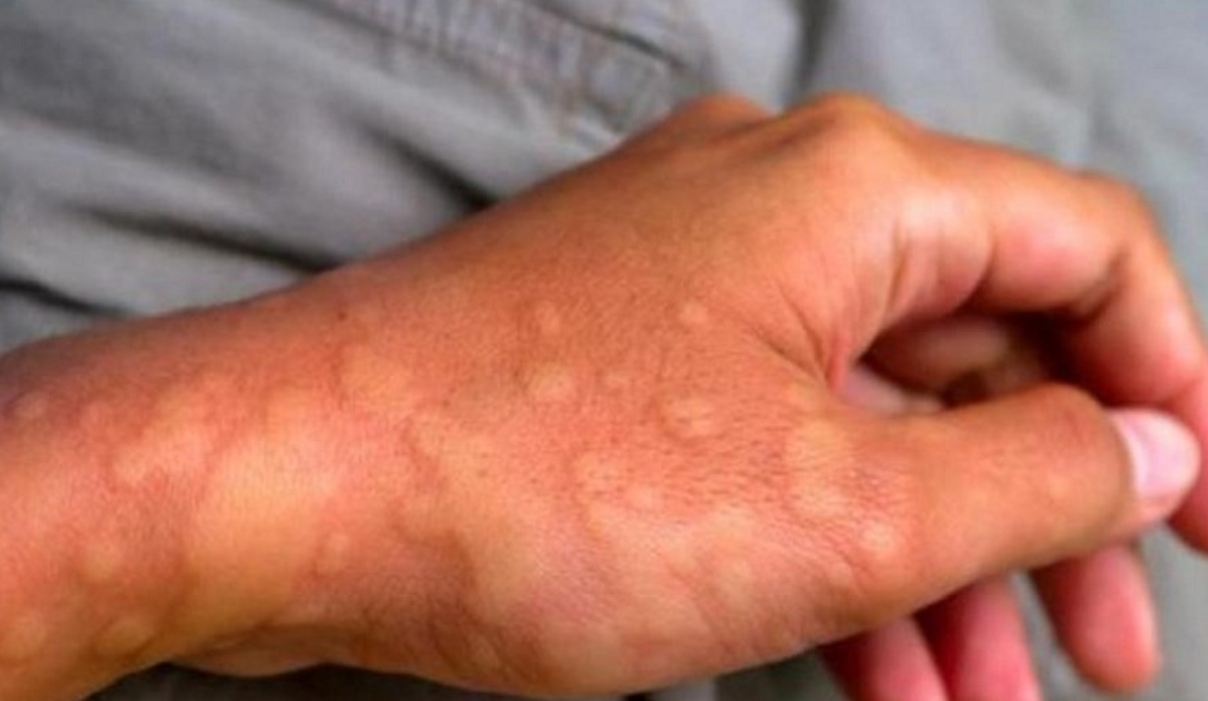 Mề đay, dị ứng b&ugrave;ng ph&aacute;t khi căng thẳng k&eacute;o d&agrave;i