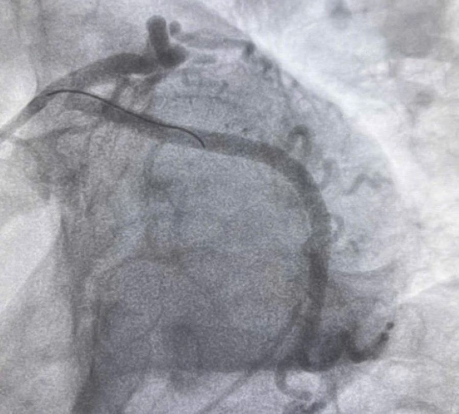 H&igrave;nh ảnh động mạch v&agrave;nh của bệnh nh&acirc;n sau đặt stent