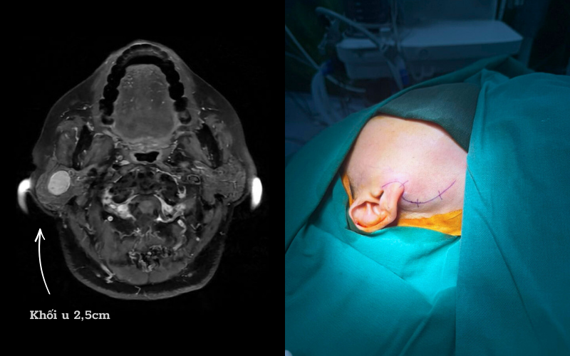 U tuyến nước bọt mang tai của chị D có vị trí phức tạp U tuyến nước bọt mang tai của chị D có vị trí phức tạp