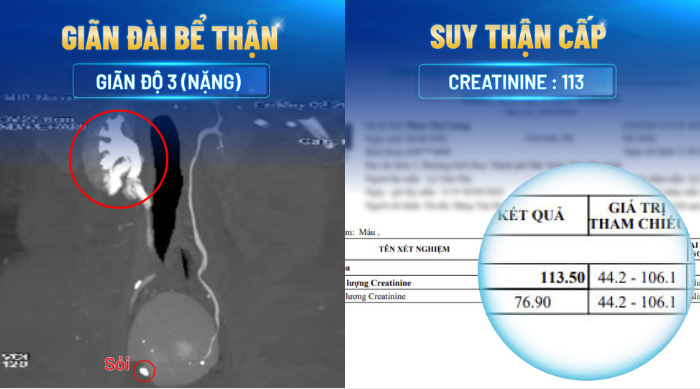 2 biến chứng g&acirc;y suy thận của bệnh nh&acirc;n V.V.H