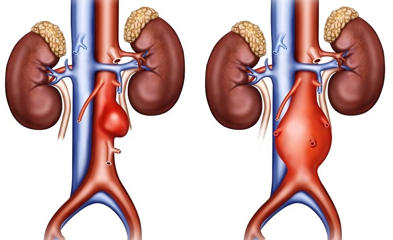 Ảnh minh họa ph&igrave;nh động mạch chủ bụng