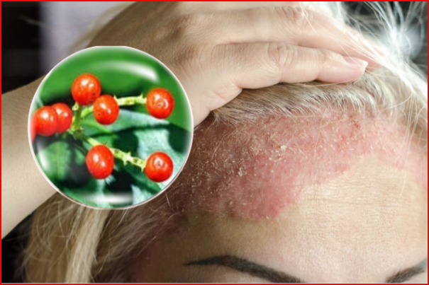 S&oacute;i rừng - thảo dược gi&uacute;p giảm triệu chứng v&agrave; kiểm so&aacute;t bệnh vảy nến l&acirc;u d&agrave;i