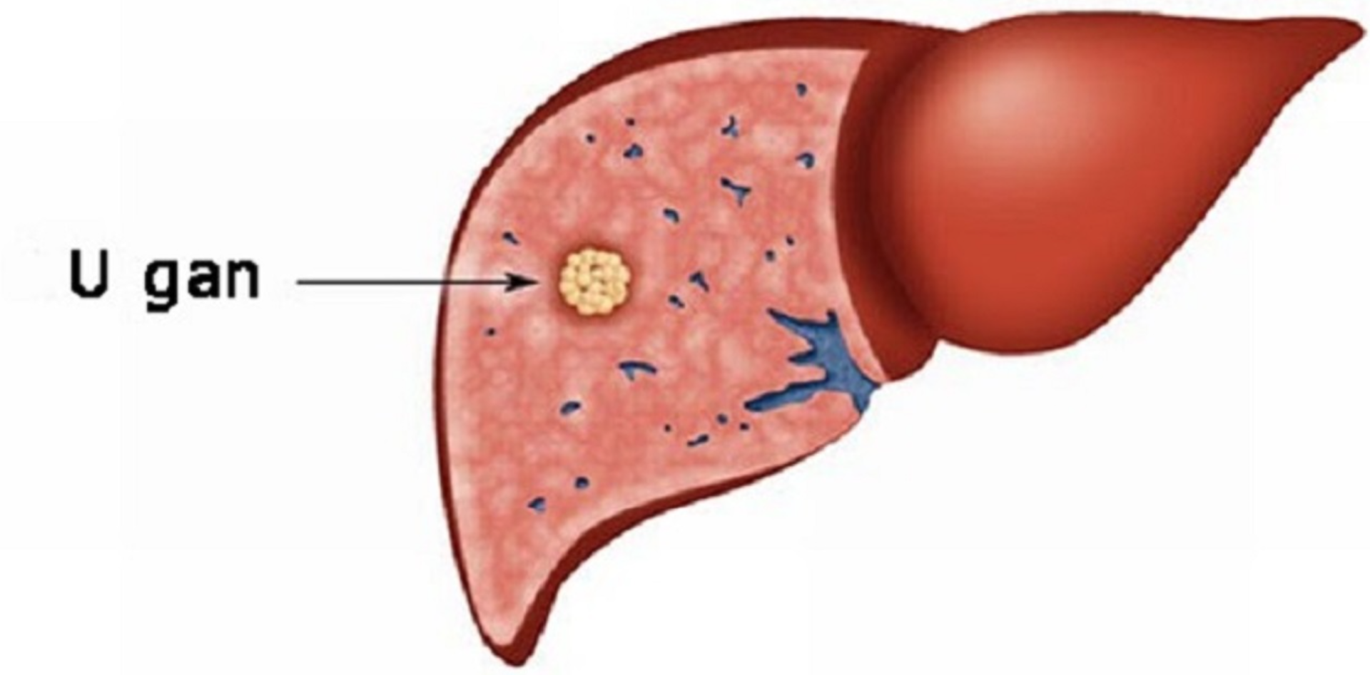 Bệnh u gan: Nhận diện sớm để tránh biến chứng nguy hiểm