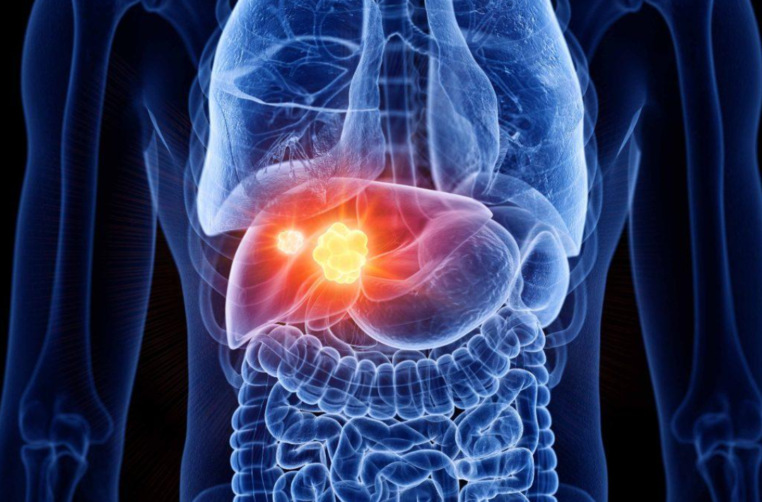 T&ugrave;y thuộc v&agrave;o k&iacute;ch thước của khối u gan m&agrave; lựa chọn phương ph&aacute;p điều trị ph&ugrave; hợp