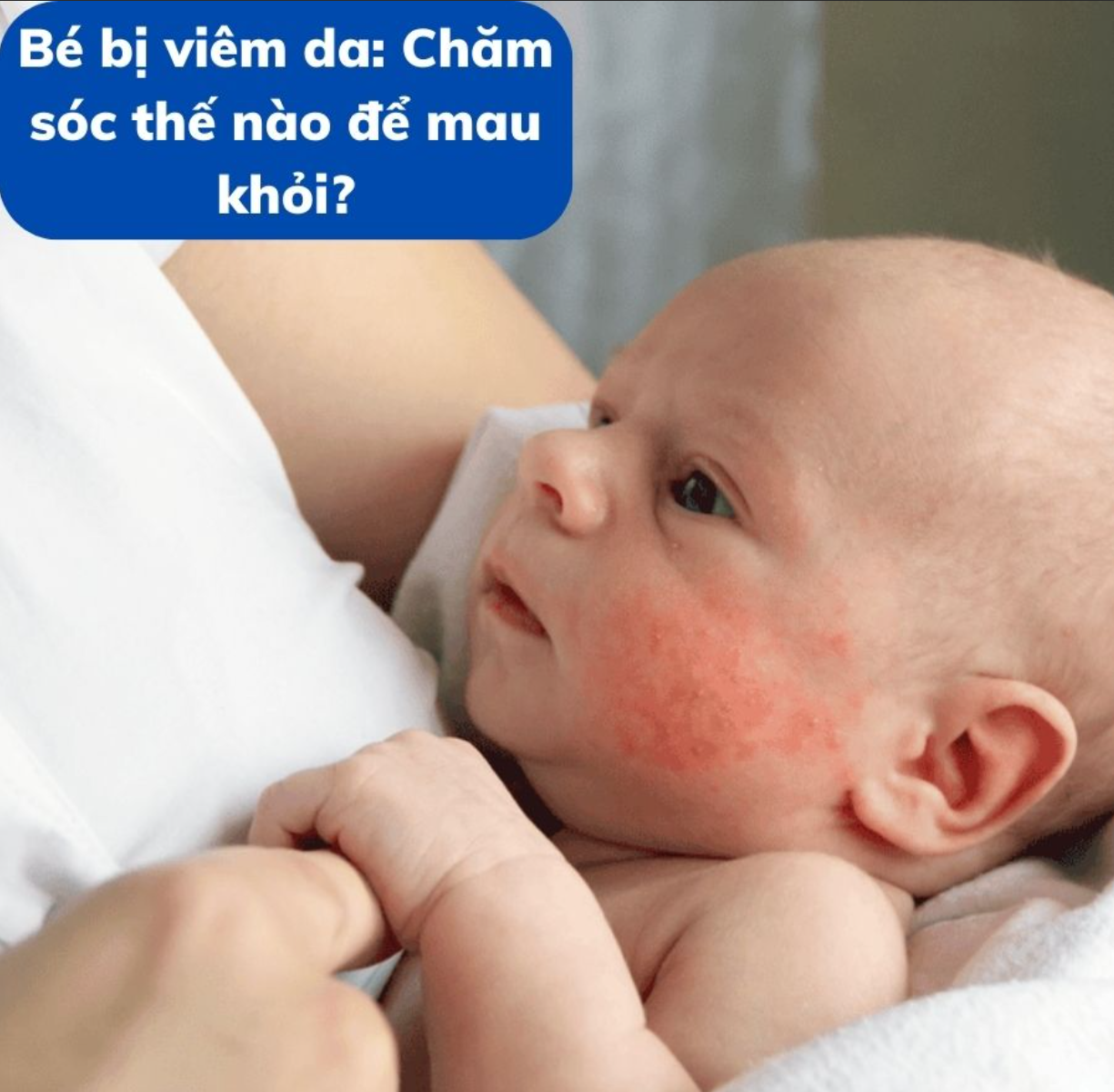 Bé bị viêm da: Chăm sóc thế nào để mau khỏi?