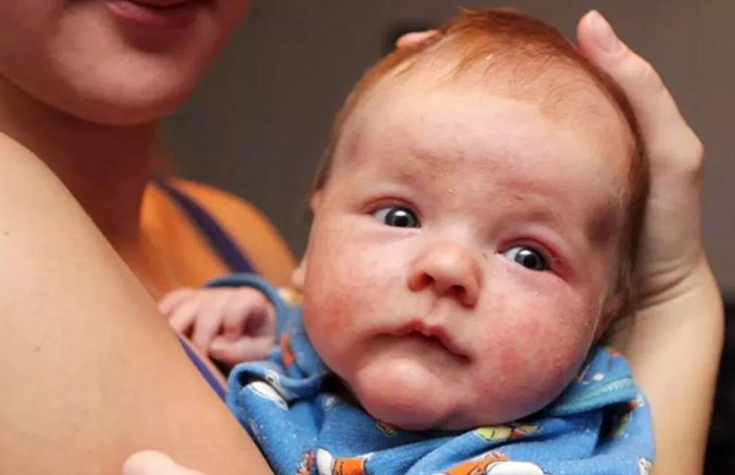 Khi vi&ecirc;m da tiến triển nặng, v&ugrave;ng da tổn thương c&oacute; thể xuất hiện mụn nước nhỏ, bong vảy hoặc rỉ dịch