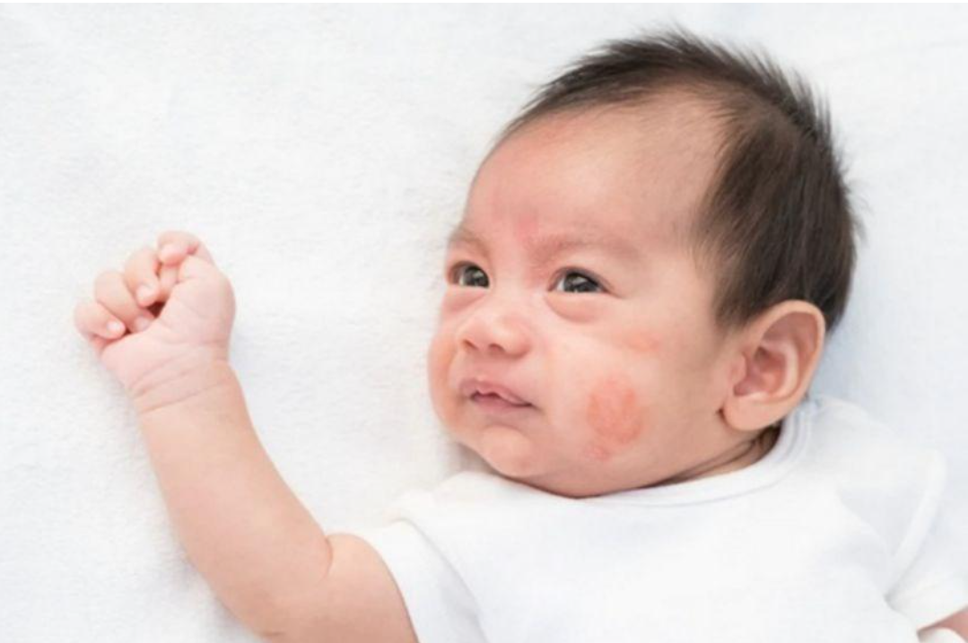 Vi&ecirc;m da khiến b&eacute; ngứa ng&aacute;y, kh&oacute; chịu