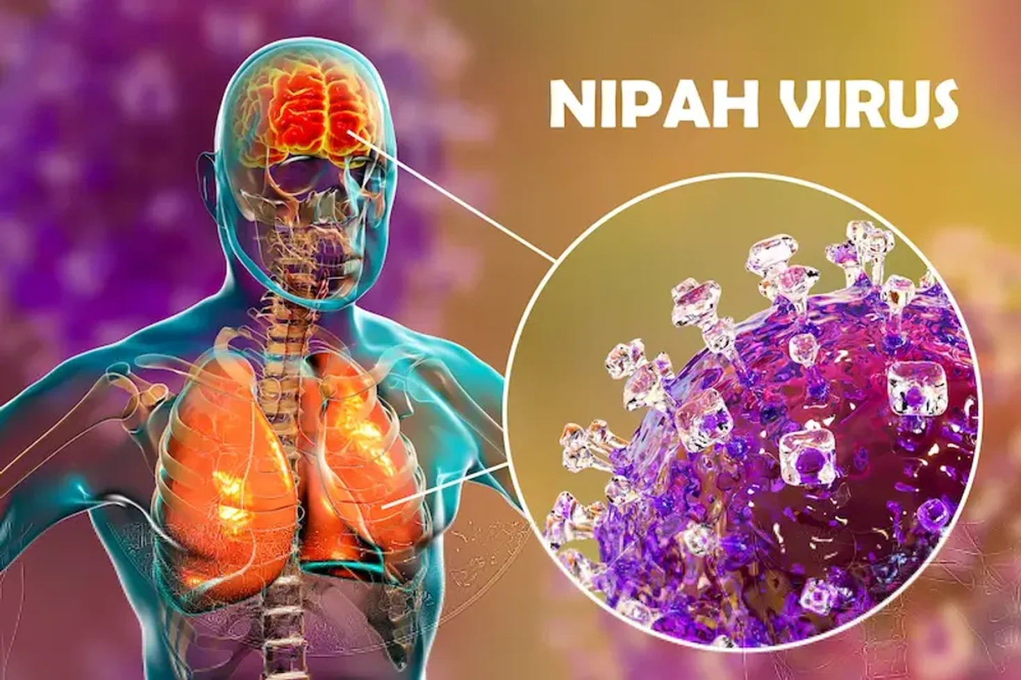 Virus Nipah có thể gây viêm hô hấp, viêm não dẫn đến tử vong (Ảnh: Getty). Virus Nipah có thể gây viêm hô hấp, viêm não dẫn đến tử vong (Ảnh: Getty).