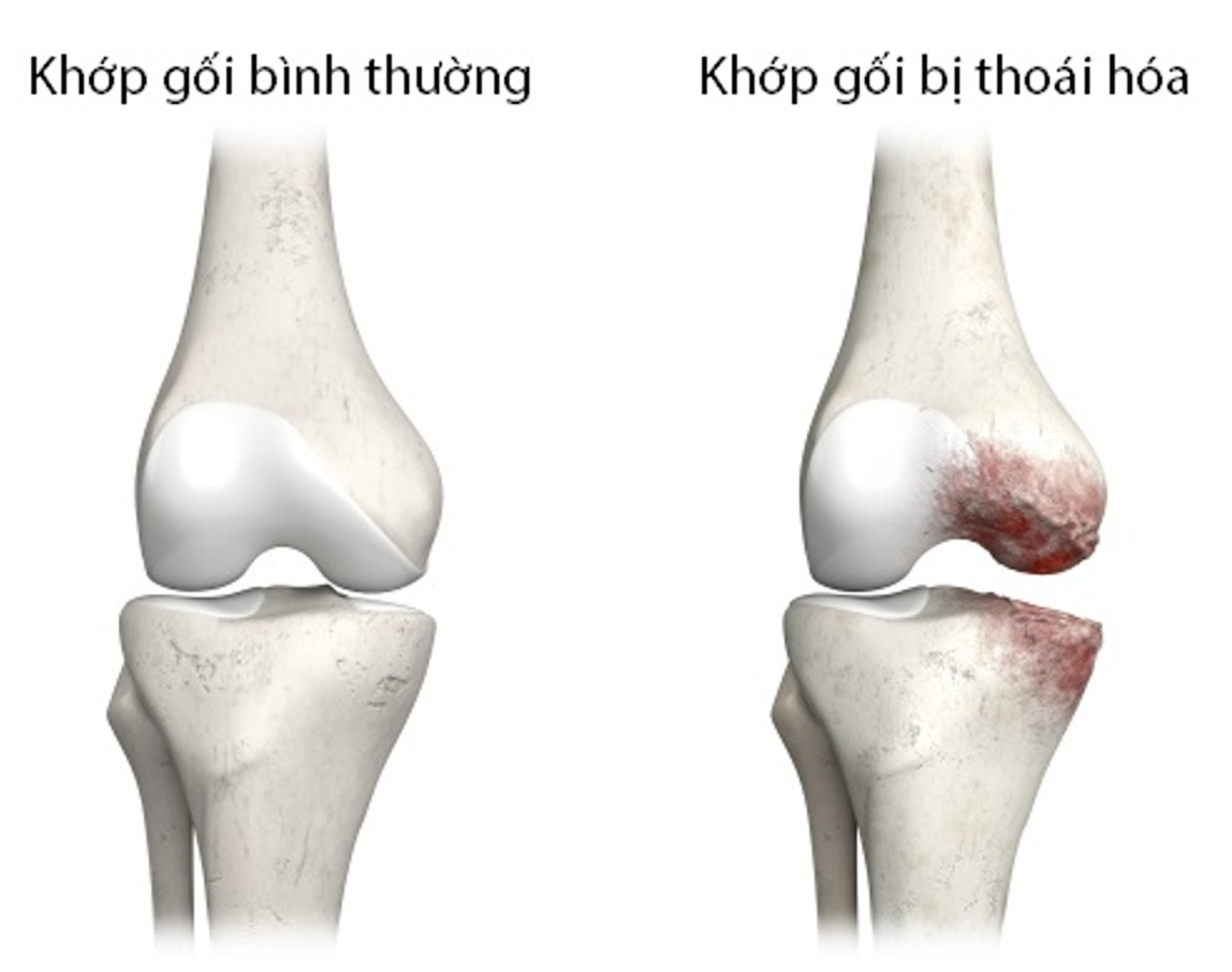 Sụn khớp bị m&agrave;i m&ograve;n v&agrave; dịch khớp suy giảm l&agrave; đặc điểm điển h&igrave;nh của tho&aacute;i h&oacute;a khớp