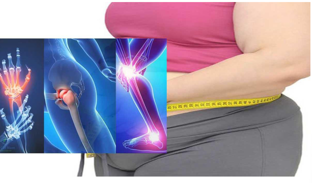 Tuổi t&aacute;c, thừa c&acirc;n v&agrave; &aacute;p lực k&eacute;o d&agrave;i l&ecirc;n khớp l&agrave; những yếu tố th&uacute;c đẩy tho&aacute;i h&oacute;a khớp tiến triển nhanh hơn