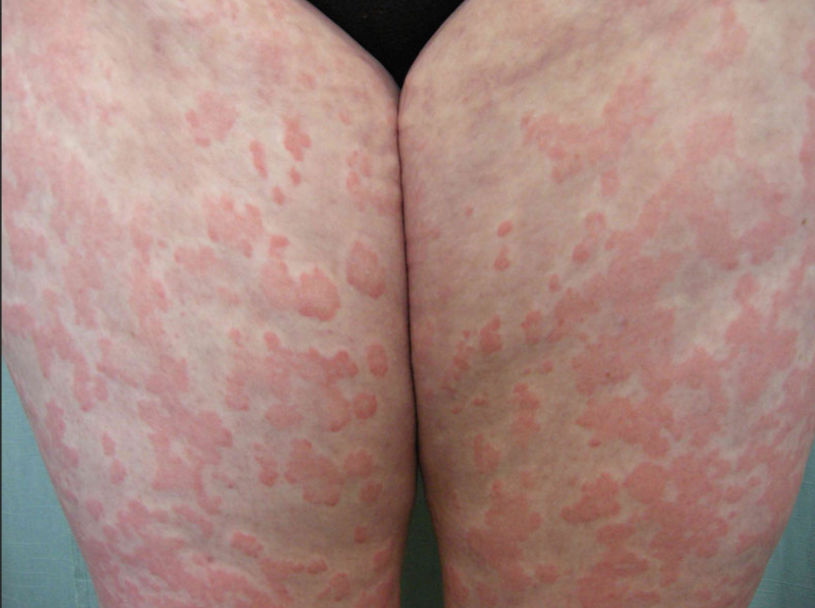 Vì sao mẩn ngứa, mề đay vẫn tái phát dai dẳng dù đã thử nhiều cách?