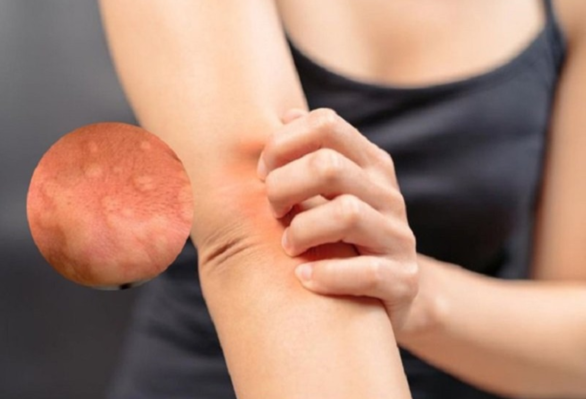 Ngứa do mề đay, dị ứng t&aacute;i đi t&aacute;i lại khiến người bệnh kh&oacute; chịu