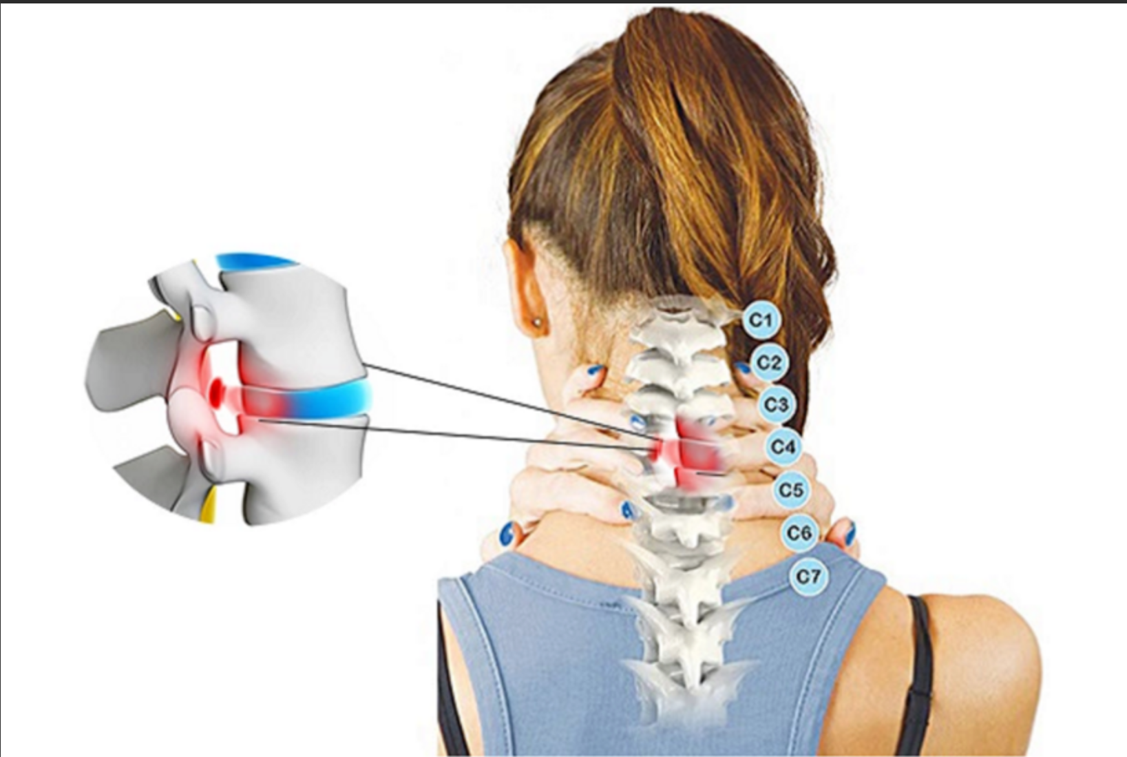 Cách chữa thoái hóa đốt sống cổ C4 C5 hiệu quả 