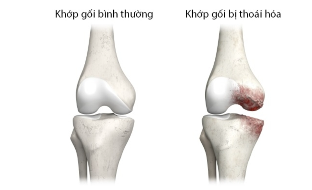Sự kh&aacute;c biệt giữa khớp khỏe mạnh v&agrave; khớp bị tho&aacute;i h&oacute;a