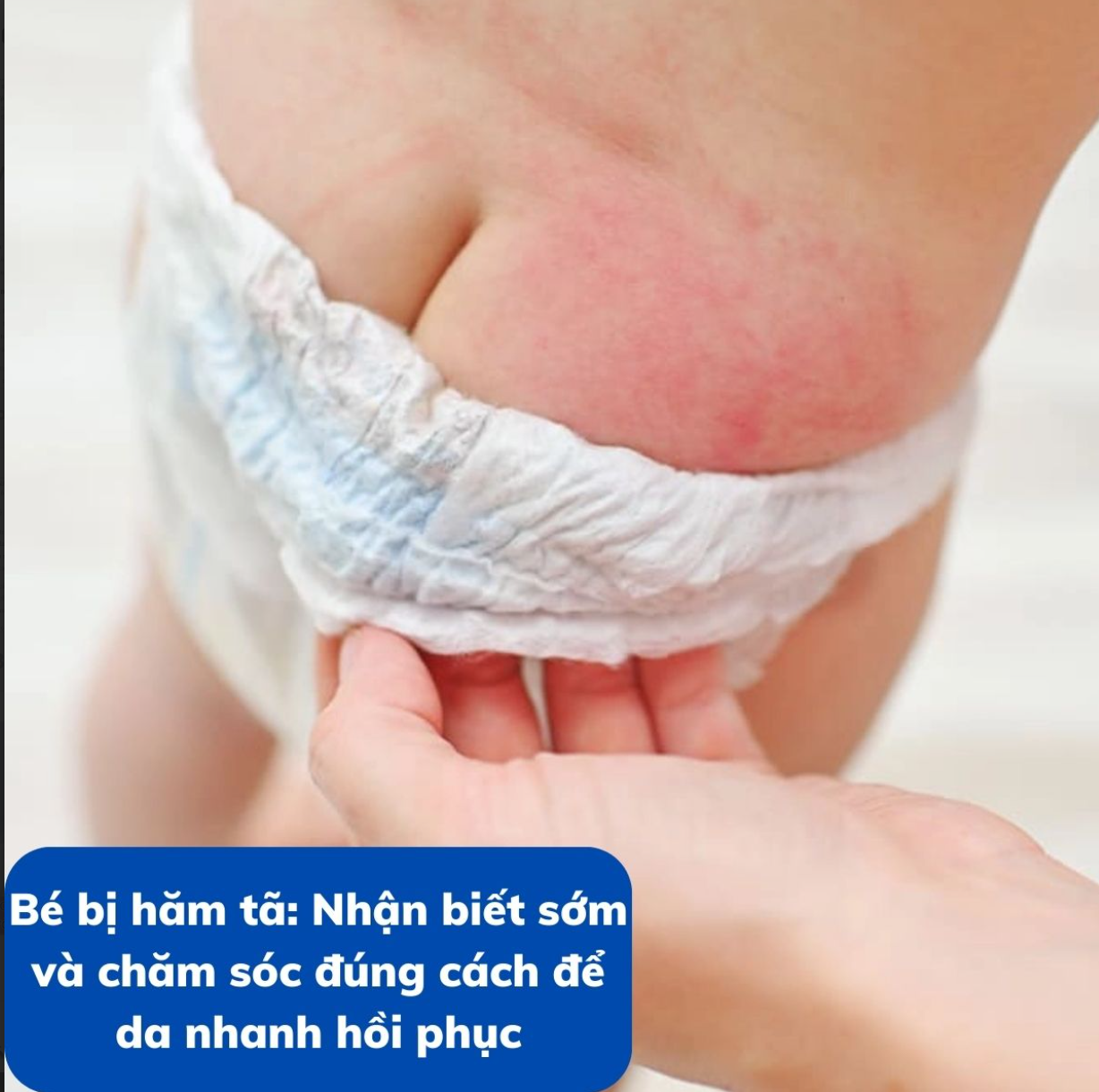 Bé bị hăm tã: Nhận biết sớm và chăm sóc đúng cách để da nhanh hồi phục