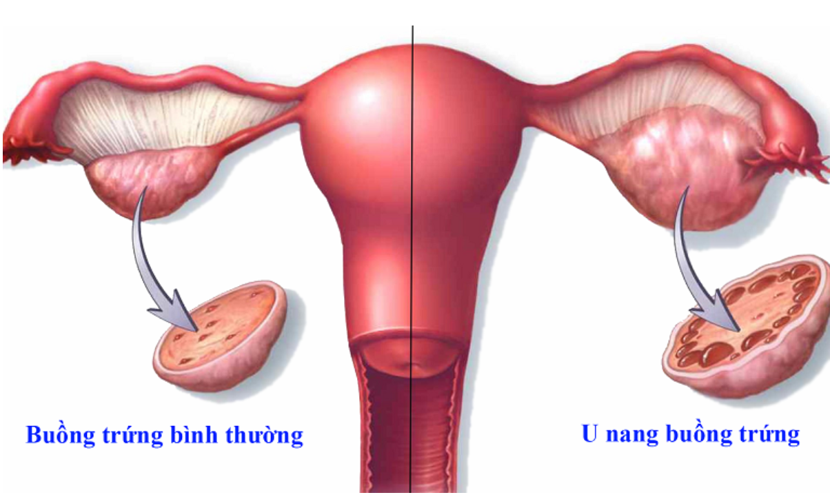 U nang buồng trứng là bệnh lý thường gặp ở phụ nữ độ tuổi sinh sản U nang buồng trứng là bệnh lý thường gặp ở phụ nữ độ tuổi sinh sản