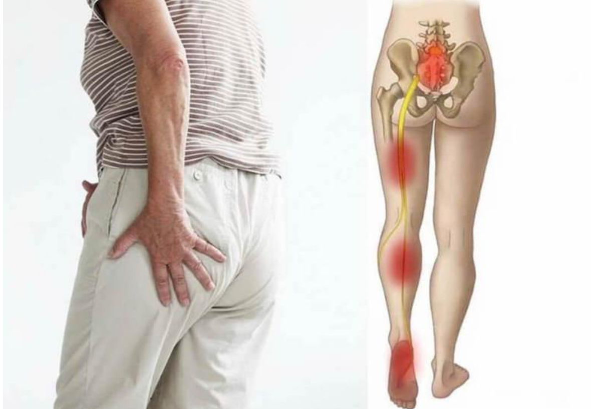 Đau lưng lan xuống m&ocirc;ng ch&acirc;n l&agrave; biểu hiện thường gặp của tho&aacute;t vị đĩa đệm L5 S1