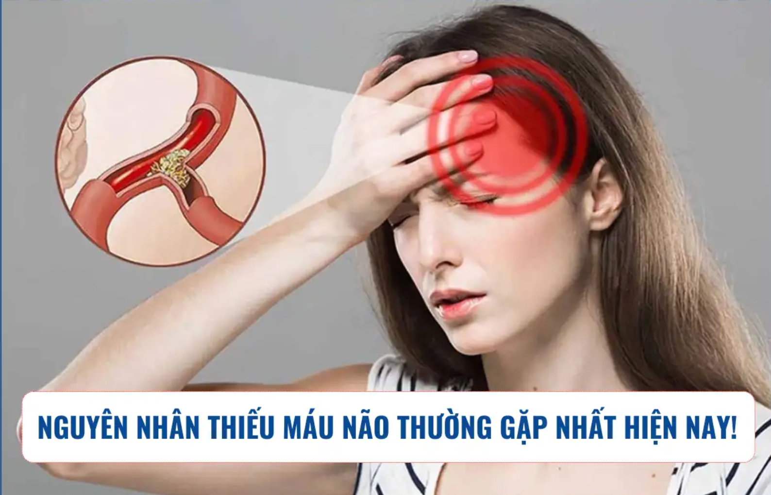 Các nguyên nhân thiếu máu não thường gặp nhất hiện nay