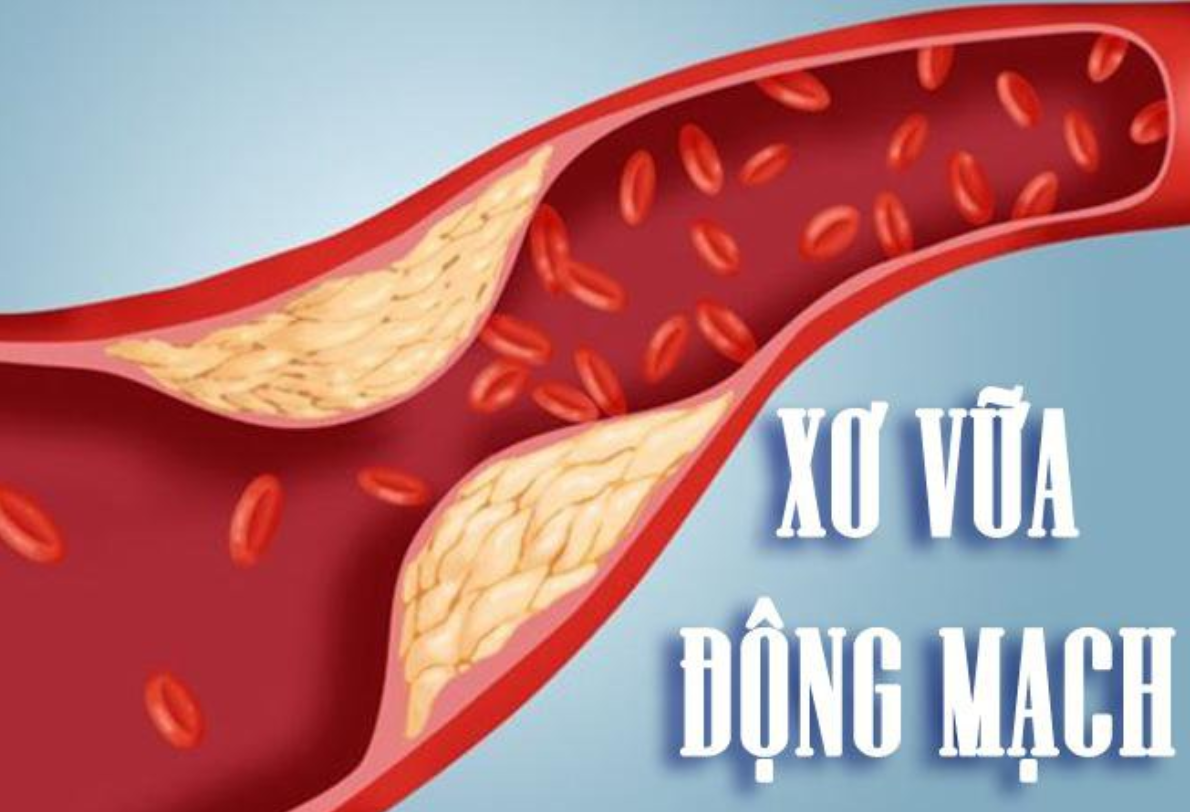 Xơ vữa động mạch l&agrave;m hẹp &ndash; tắc mạch m&aacute;u, cản trở lưu th&ocirc;ng v&agrave; g&acirc;y thiếu m&aacute;u n&atilde;o
