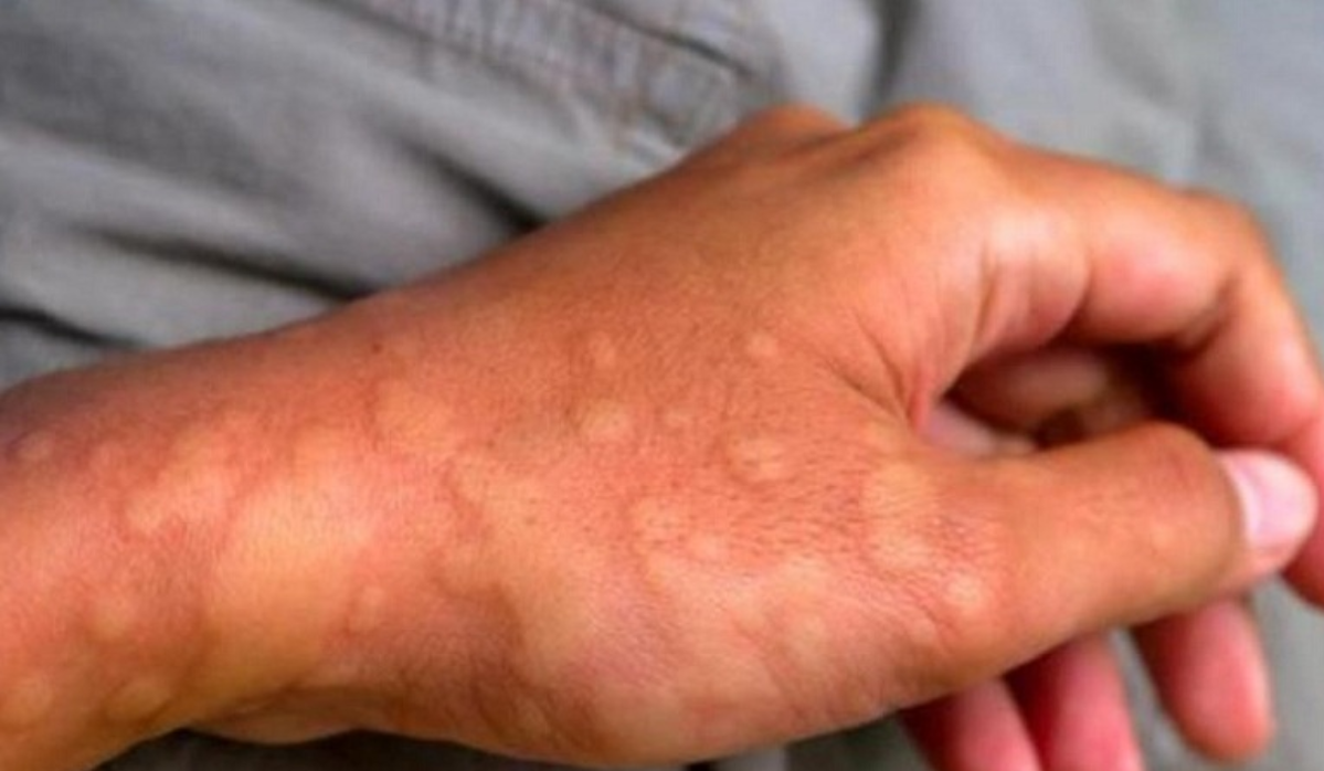 Mề đay, dị ứng b&ugrave;ng ph&aacute;t sau khi ốm do sức đề kh&aacute;ng của cơ thể bị suy giảm, chưa hồi phục ho&agrave;n to&agrave;n