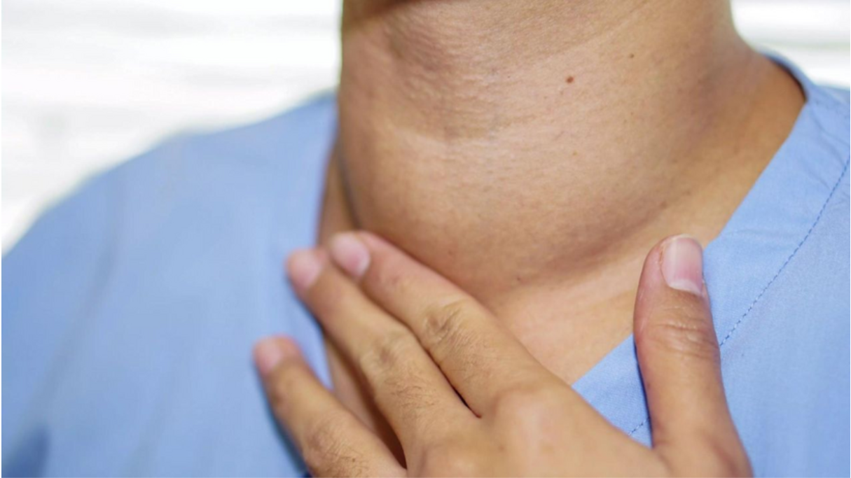 Bướu tuyến giáp là tình trạng tuyến giáp phì đại bất thường Bướu tuyến giáp là tình trạng tuyến giáp phì đại bất thường