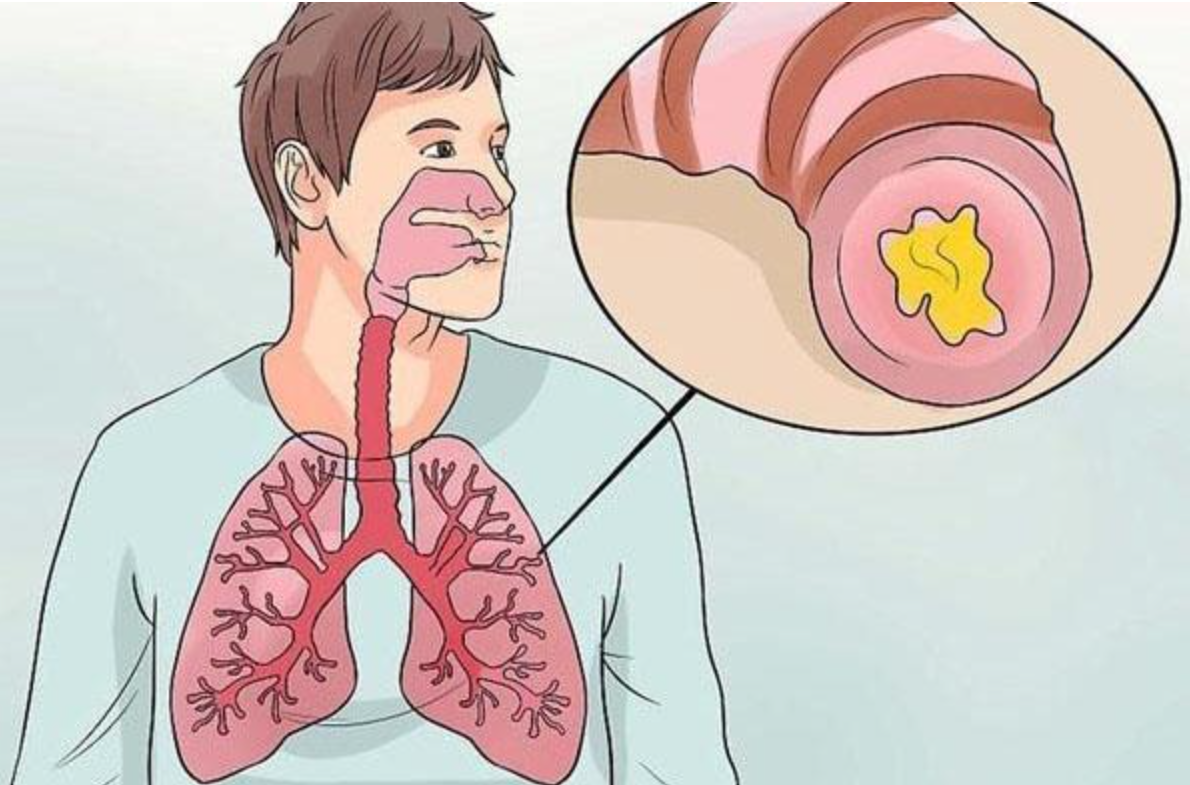 Vi&ecirc;m phổi mạn t&iacute;nh khiến suy giảm chức năng h&ocirc; hấp