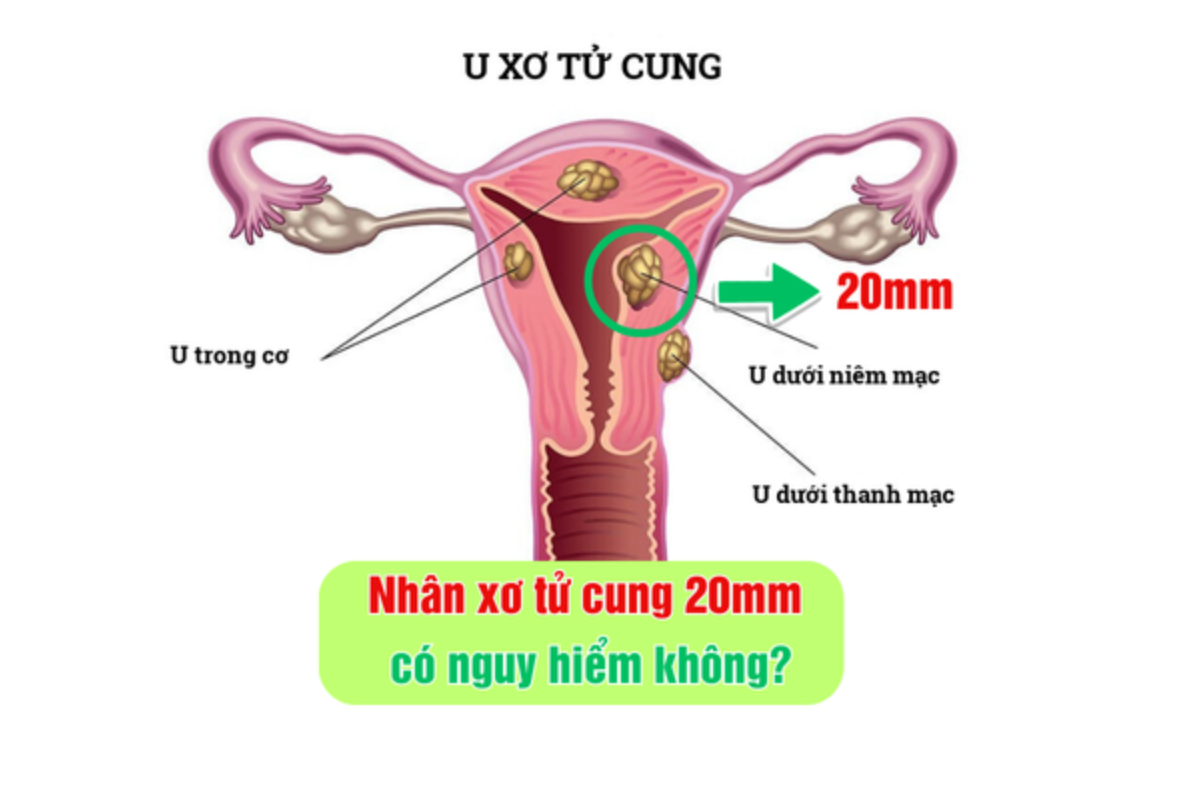 Nhân xơ tử cung 20mm có nguy hiểm không?