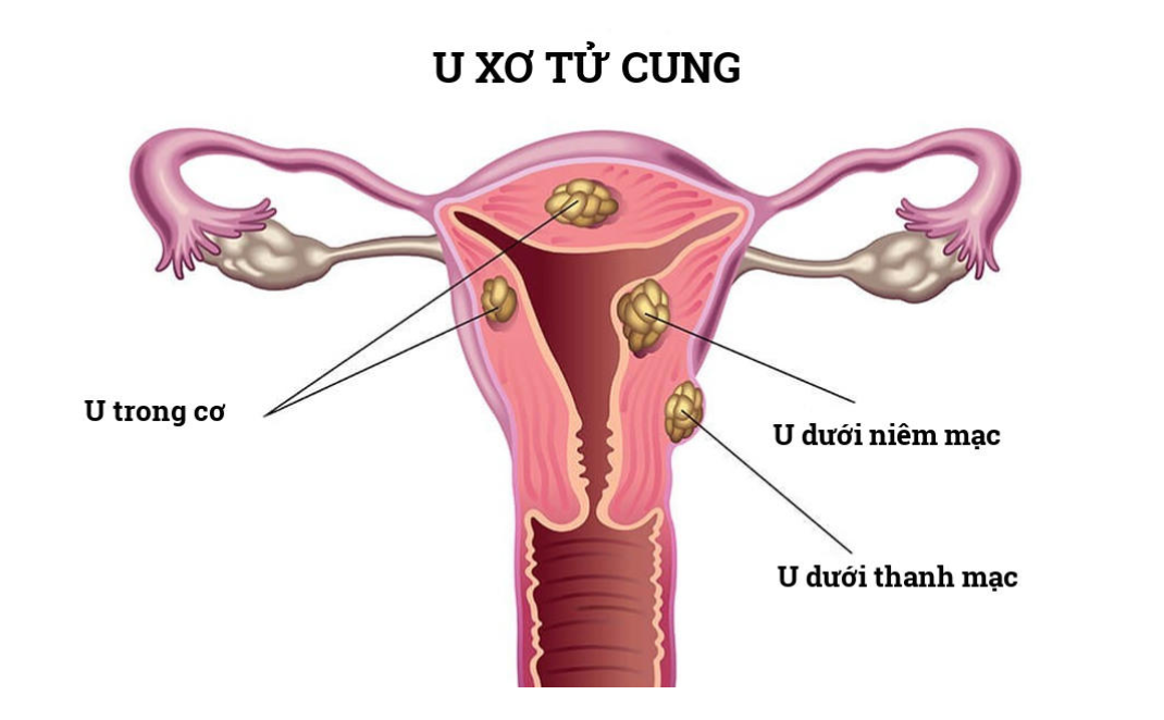 Nhân xơ tử cung 20mm nằm dưới niêm mạc có thể ảnh hưởng đến chu kỳ kinh nguyệt Nhân xơ tử cung 20mm nằm dưới niêm mạc có thể ảnh hưởng đến chu kỳ kinh nguyệt