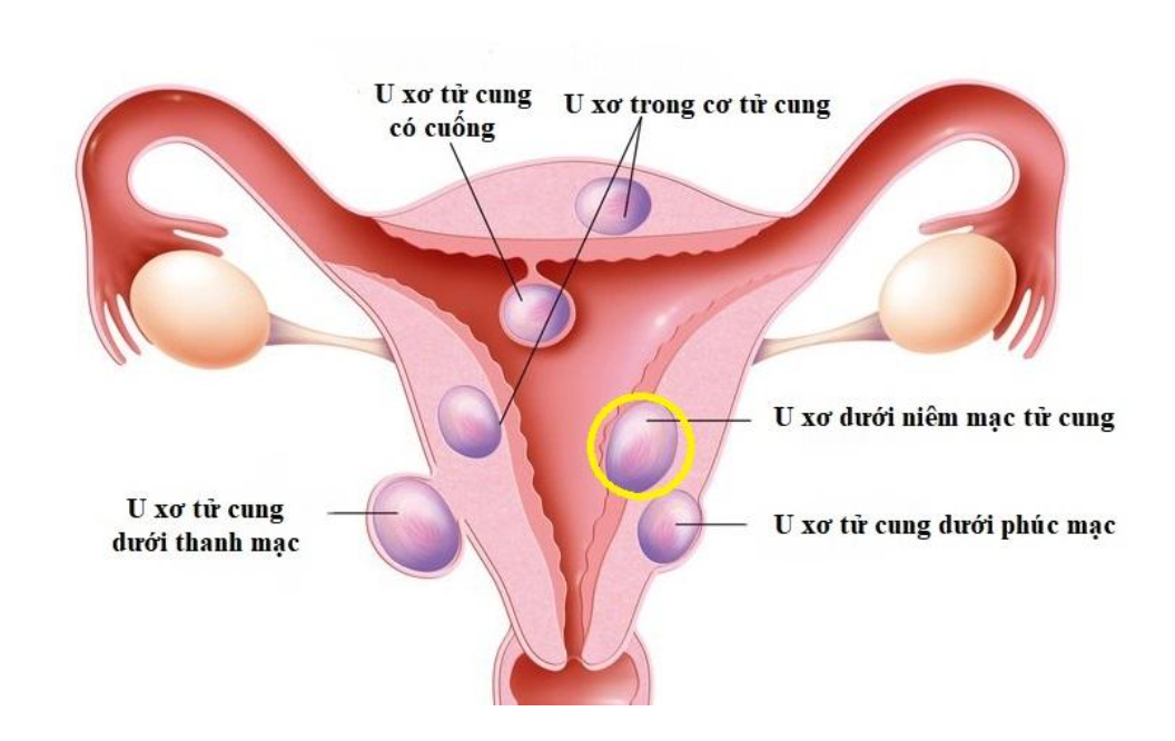 Nhân xơ tử cung 20mm được xếp vào loại u nhỏ Nhân xơ tử cung 20mm được xếp vào loại u nhỏ
