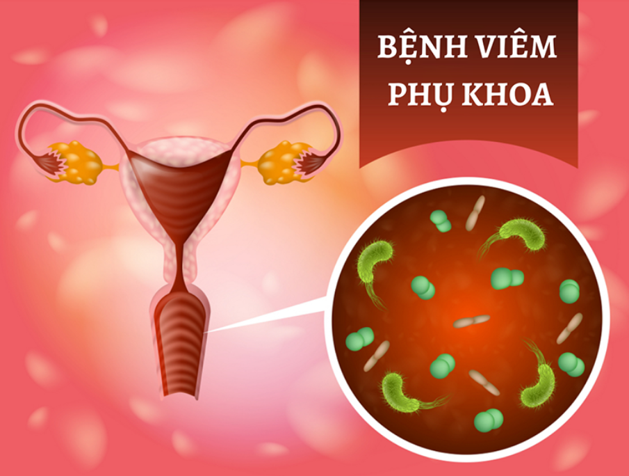 Kinh nguyệt kh&ocirc;ng đều c&oacute; thể l&agrave;m tăng nguy cơ vi&ecirc;m nhiễm phụ khoa