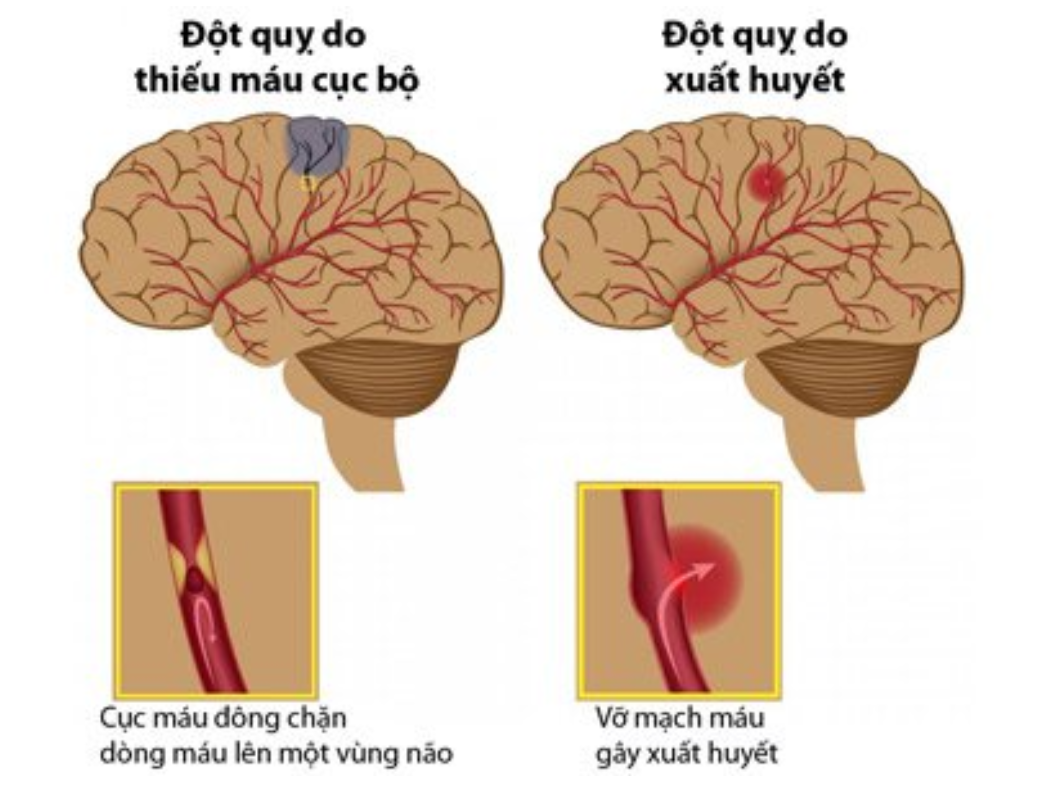 C&oacute; 2 dạng tai biến mạch m&aacute;u n&atilde;o l&agrave; tai biến do tắc mạch v&agrave; xuất huyết n&atilde;o