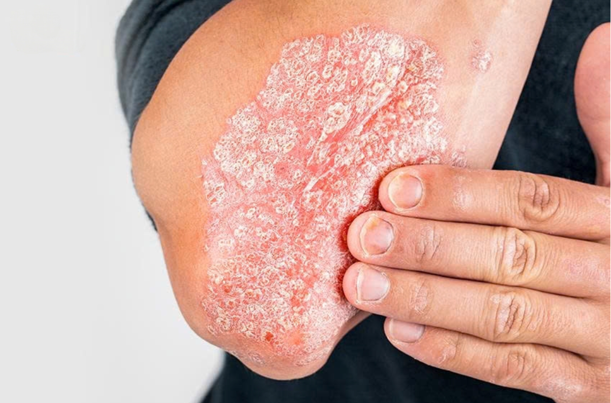 Vảy nến l&agrave; bệnh tự miễn mạn t&iacute;nh, h&igrave;nh th&agrave;nh do rối loạn miễn dịch khiến tế b&agrave;o da tăng sinh nhanh v&agrave; bong vảy