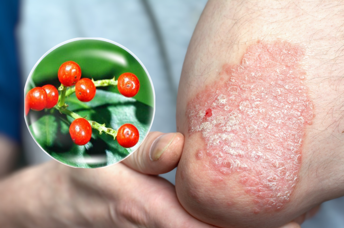 S&oacute;i rừng - thảo dược hỗ trợ tăng miễn dịch, giảm vi&ecirc;m v&agrave; gi&uacute;p kiểm so&aacute;t vảy nến ổn định hơn