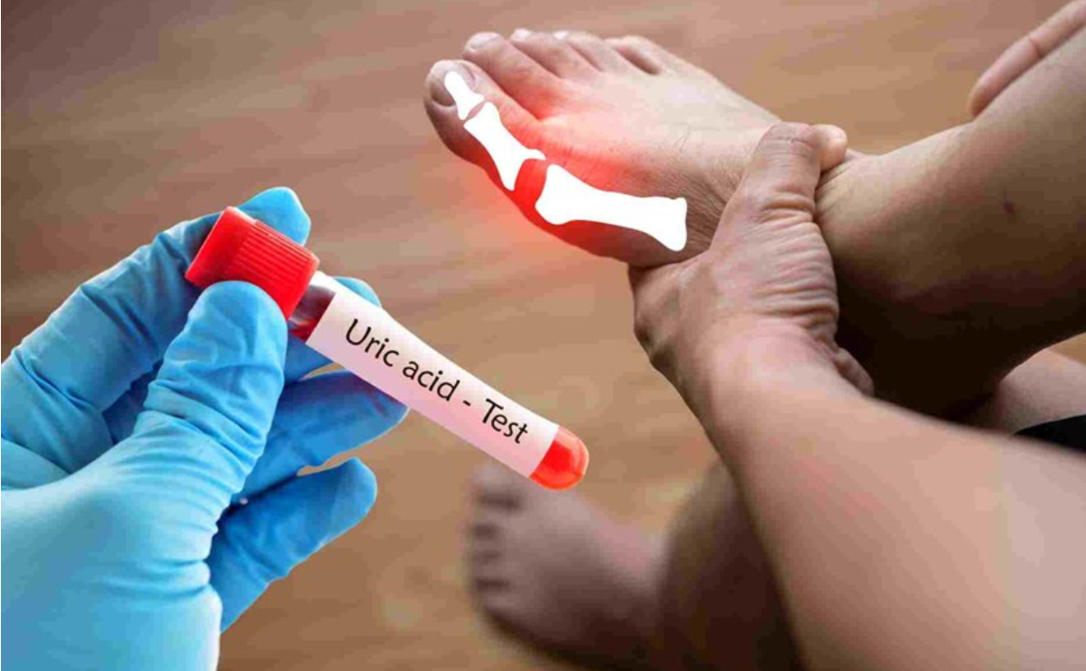 Kiểm soát acid uric hàng ngày giúp cải thiện cơn đau gút Kiểm soát acid uric hàng ngày giúp cải thiện cơn đau gút