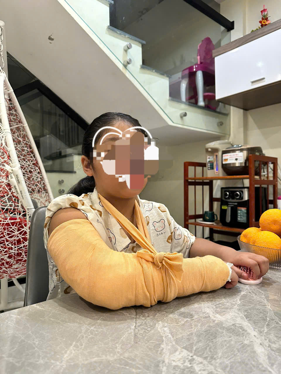 Ch&aacute;u Th.. đang d&ugrave;ng d&acirc;y đeo mềm treo c&aacute;nh tay