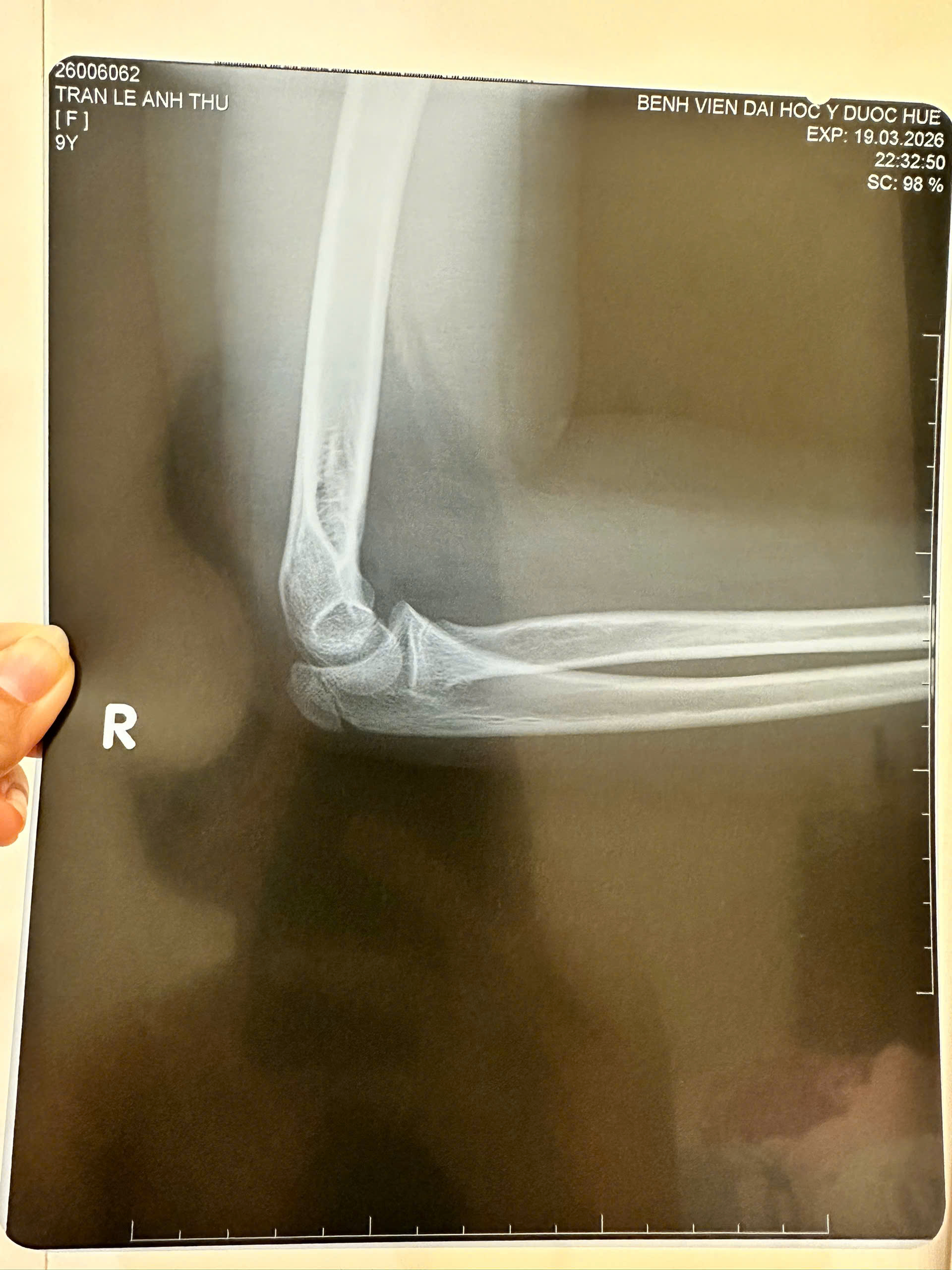 H&igrave;nh ảnh chấn thương của ch&aacute;u Th..